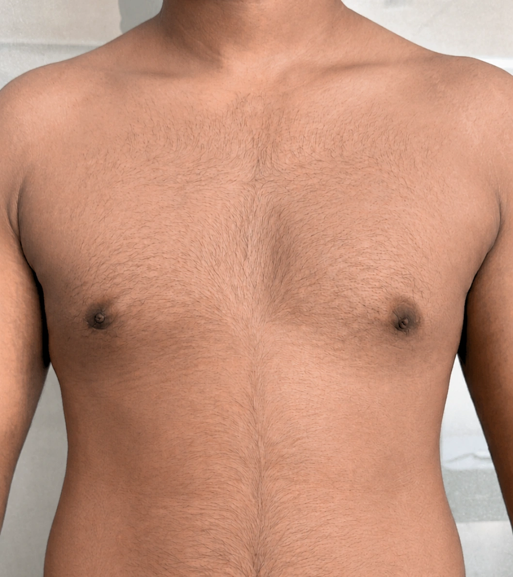 Gynecomastia after - TRUE ARTIS patient