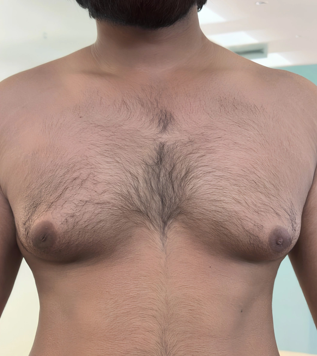 Gynecomastia before - TRUE ARTIS patient